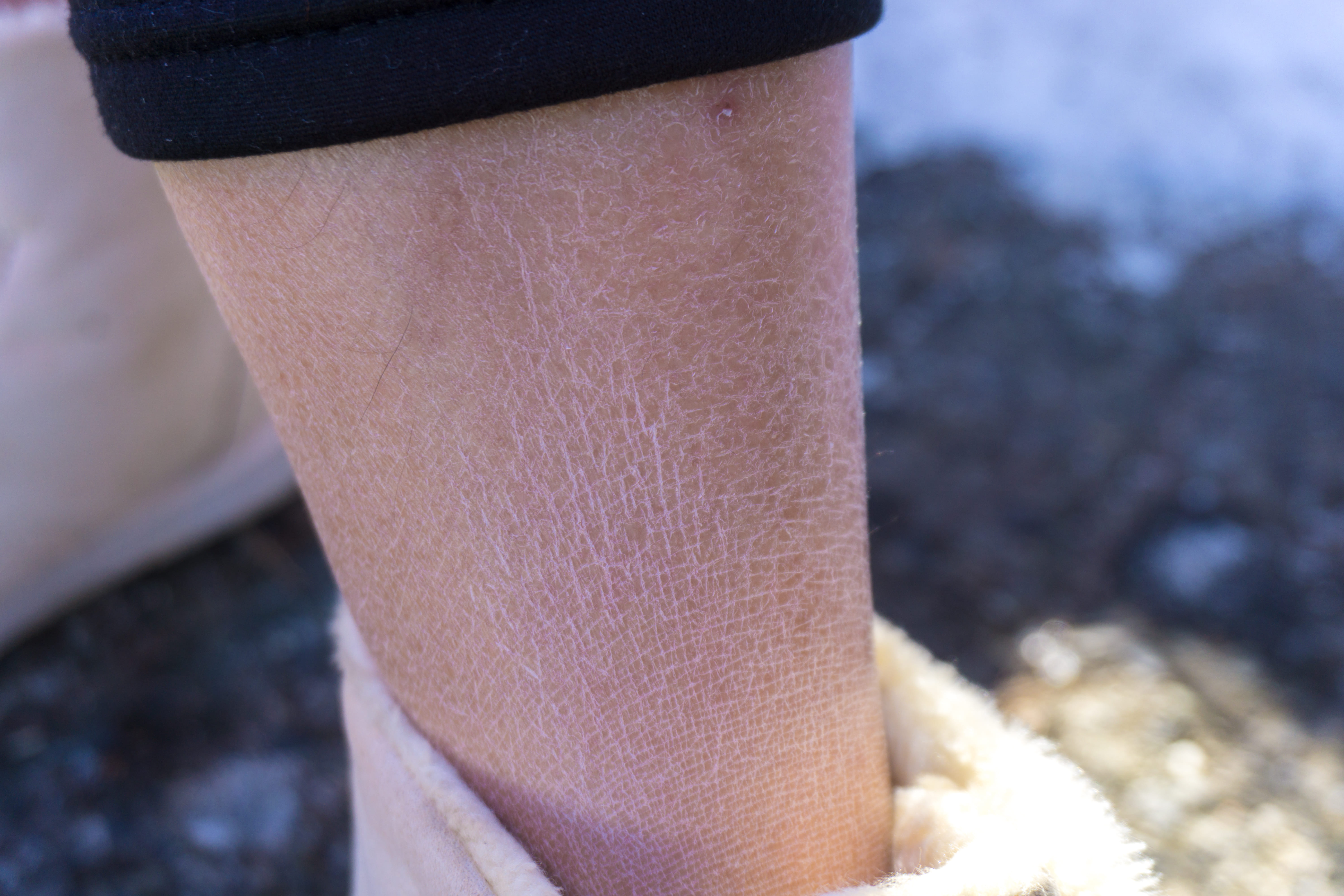 Сухая кожа на ногах: что делать с сухостью