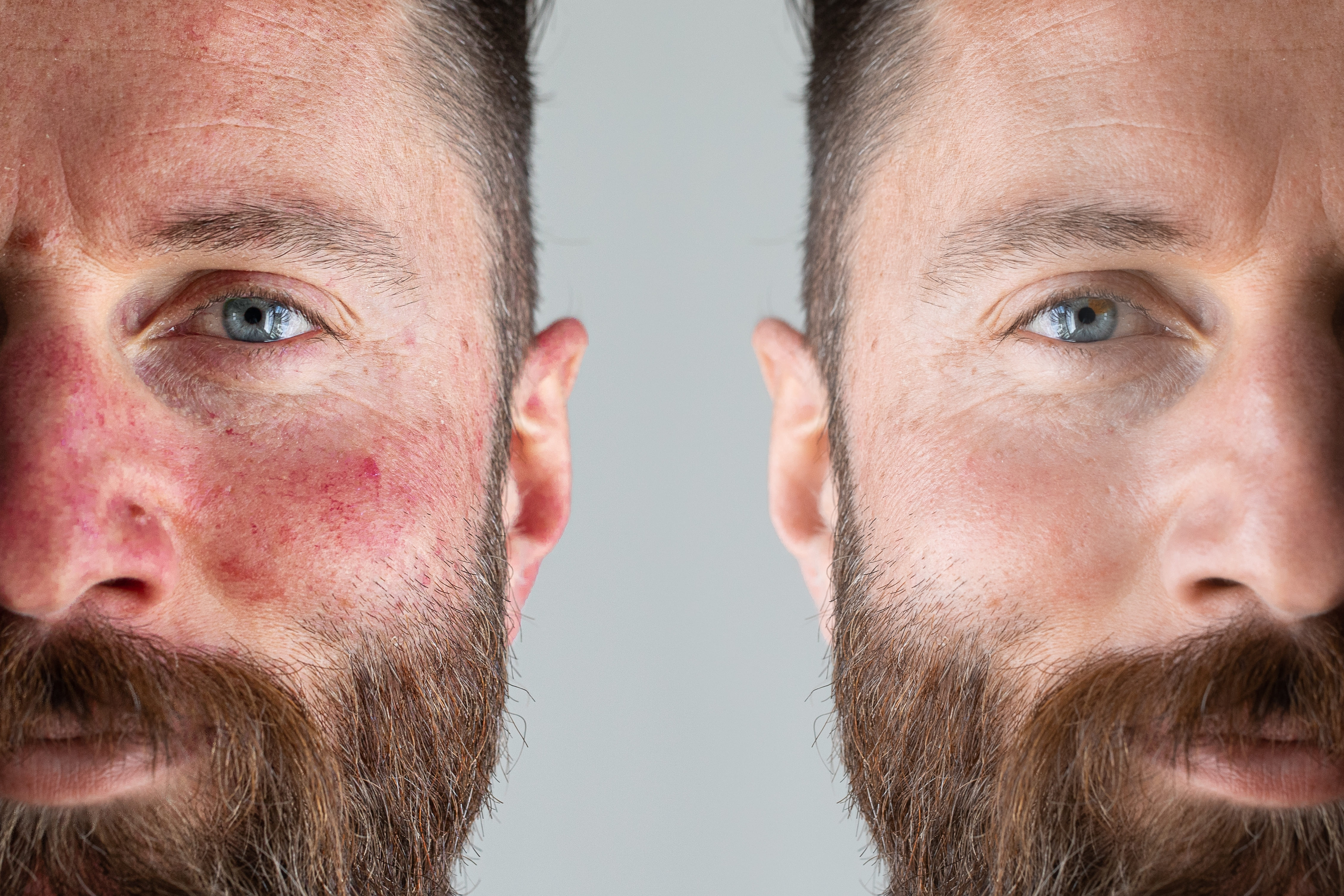 Розацеа кожи на лице: симптомы и лечение | Клиника Рассвет