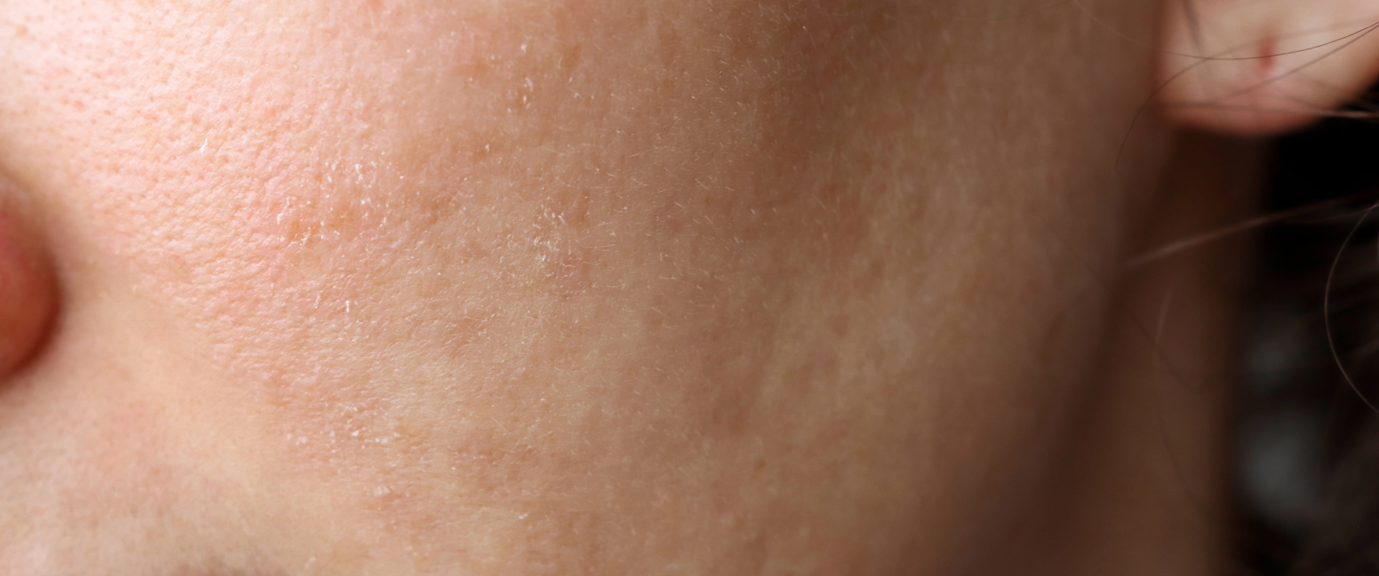 Догляд за сухою шкірою обличчя: причини та ознаки сухості шкіри,  рекомендації щодо догляду