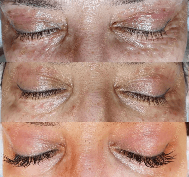 Plinest Eye